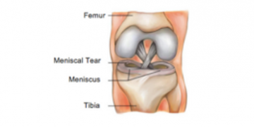 Meniscal injuries